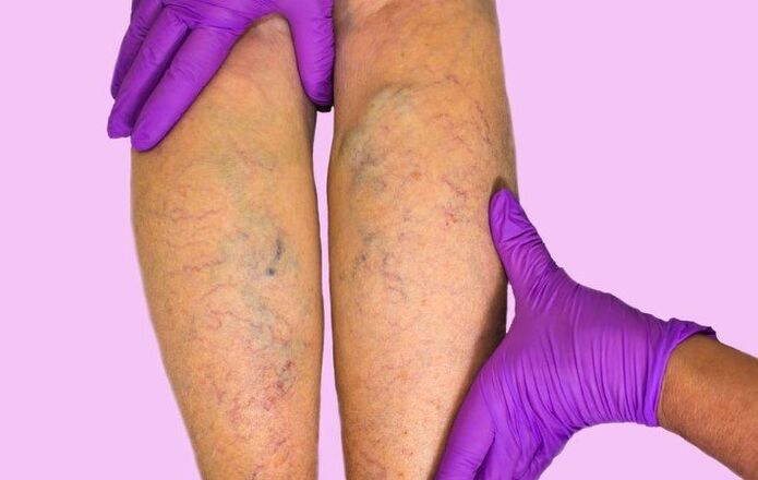 Dilated veins of the lower extremities