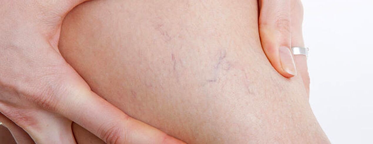 how varicose veins are formed