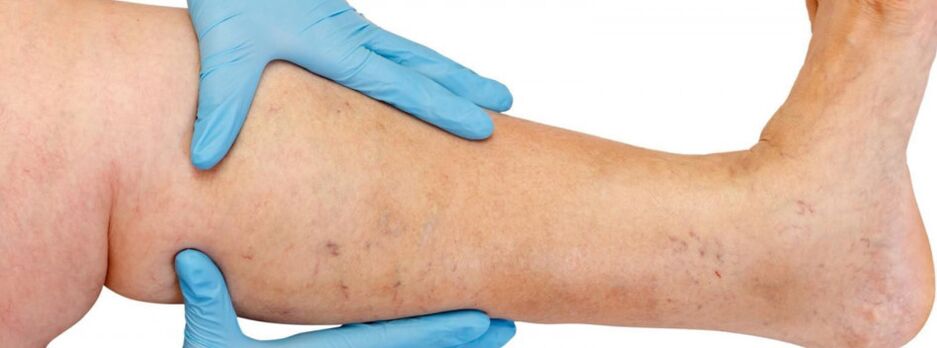 varicose veins