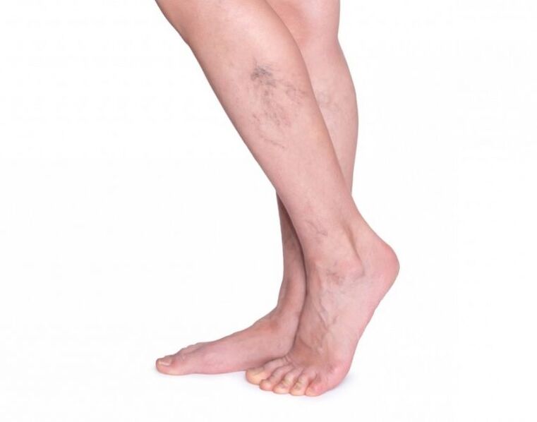 varicose veins before VariForce treatment